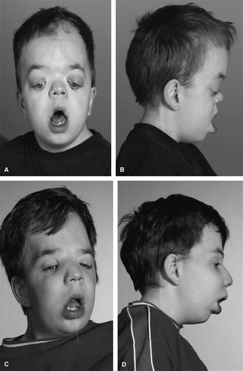 Patient With Crouzon Syndrome Severe Mental Retardation And Autism