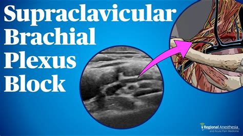 Prac Live Webinar Series Supraclavicular Brachial Plexus Block My Xxx