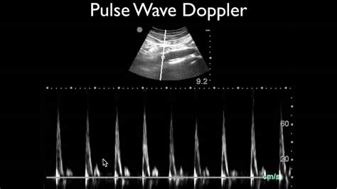 Ultrasound Physics Scanning Modes Pulsed Wave Doppler Youtube