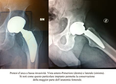 Minimally Invasive Hip Replacement Dott Gianluca Castellarin