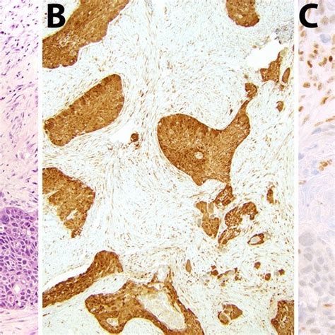 Oropharyngeal Squamous Cell Carcinoma With Discordant Positive P16 Ihc