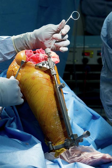 Knee Replacement Surgery Photograph By Mark Thomasscience Photo