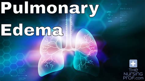 Nursing Emergencies Pulmonary Edema Youtube
