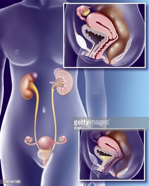 Woman With Urinary Incontinence Frontal View Of The Female Urinary