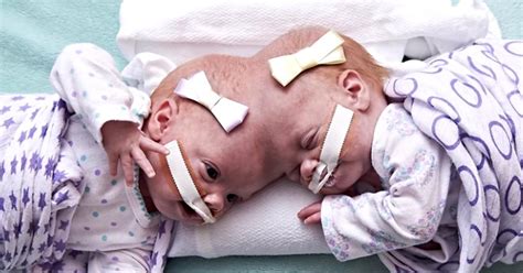 A Year After Being Separated Conjoined Twins Celebrate Their New Lives