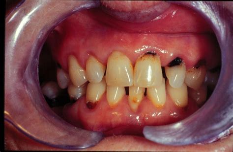 Cavities Mouth And Dental Disorders Merck Manuals Consumer Version