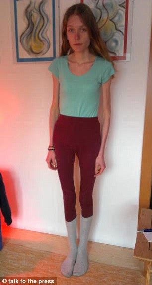 Anorexic Student Hannah Koestler From Warwick Documents Her Recovery On