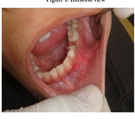 figure 1 from radicular cyst on deciduous molar or dentigerous cyst on permanent tooth