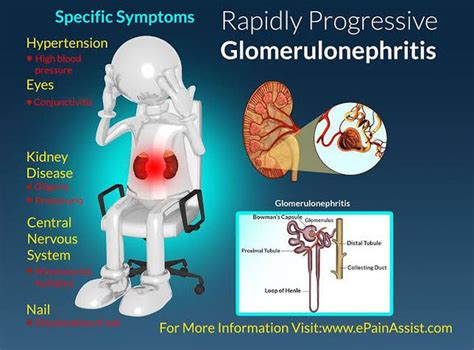 Glomerulonephritis Symptoms Medizzy