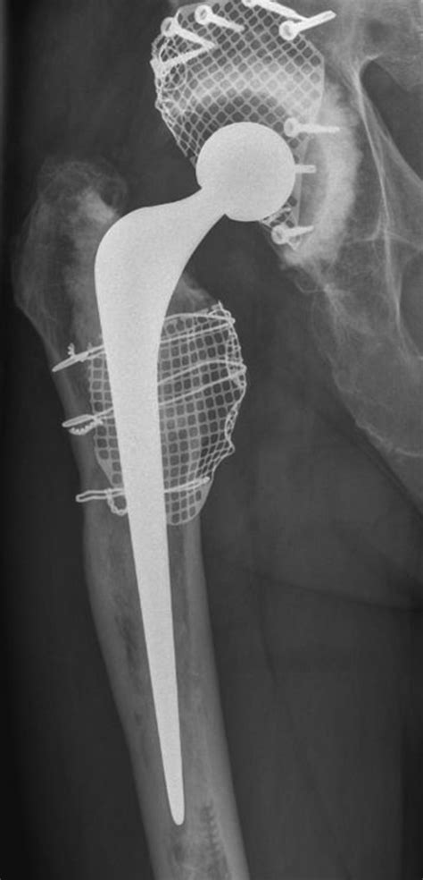 The Use Of A Long Stem Cemented Femoral Component In Revision Total Hip