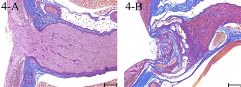 Figure 4 From Anterior Segment Dysmorphogenesis Of The Eye And Glaucoma