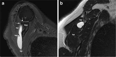Spectrum Of Mri Features Of Ganglion And Synovial Cysts Insights Into