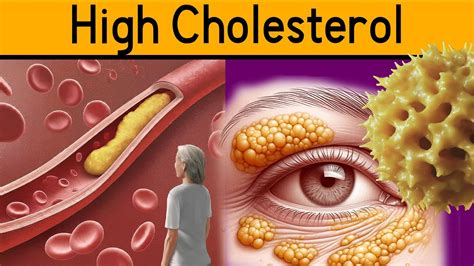 5 Signs Of High Cholesterol The Silent Dangers Of High Cholesterol