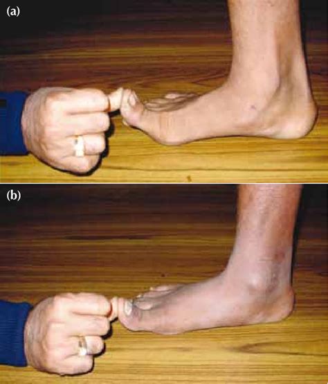 A Positive And B Negative Great Toe Extension Test Download