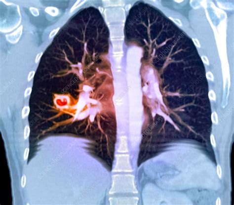 Lung Lesions Ct Scan Stock Image M2400784 Science Photo Library