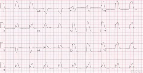 The Initial Electrocardiogram Revealed St Segment Elevation In Leads Ii