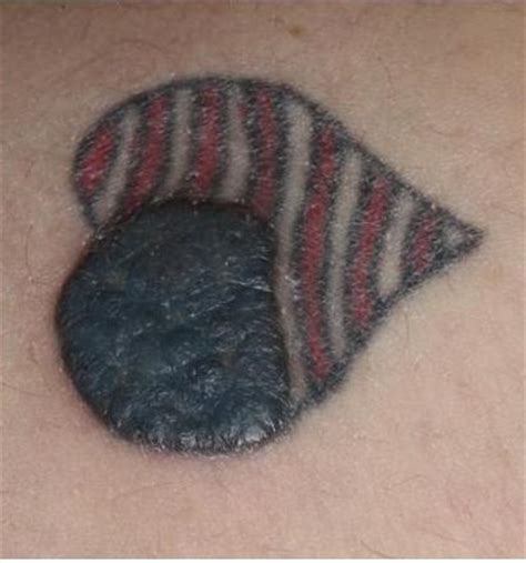 They make fine cuts and fill them with color. Inflammatory Tattoo Reaction - The Clinical Advisor