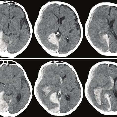 Delayed Traumatic Intracerebral Hematoma Note A A Falco Tentorial