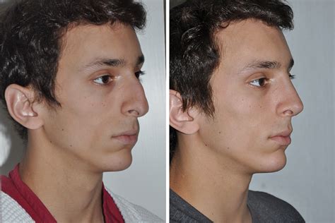 Male nose reshaping surgery korea. Rhinoplasty, Nose Surgery, Nose Job for Men in New York ...