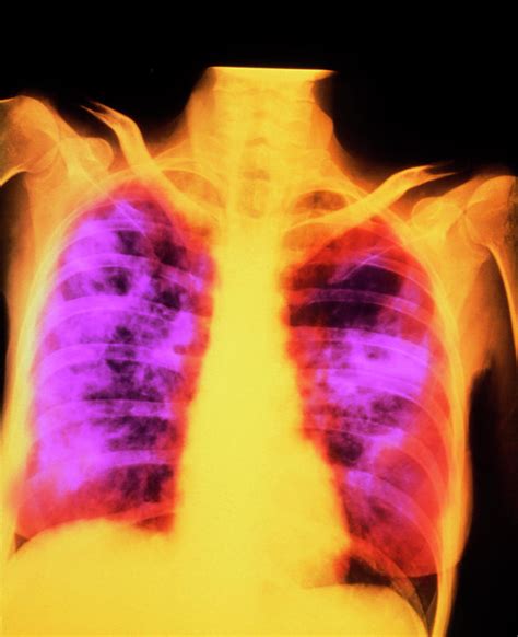 False Colour Chest X Ray Post Primary Tuberculosis Photograph By