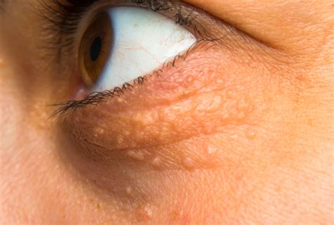 Ways To Deal With Cholesterol Deposits Around Your Eyes