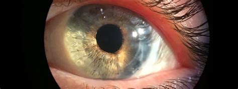 How Does The Cornea Affect Vision