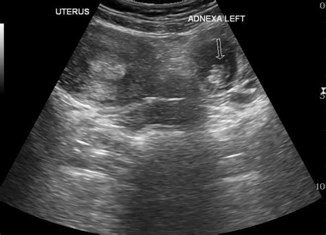 A fetal ultrasound is a test that uses sound waves to create an image of your unborn baby on a video screen. Ectopic Pregnancy - Core EM