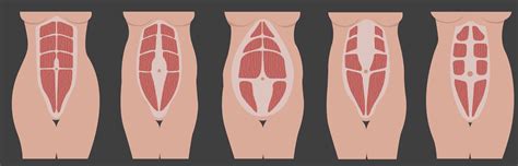 O Que é Diastase Dos Musculos Retos Abdominais