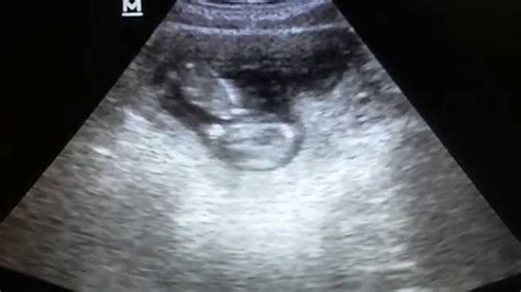 Gambar Bayi Usia Kandungan 3 Bulan Adzka