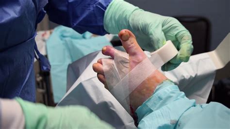 Minimally Invasive Foot Surgery Hammertoes Correction Youtube