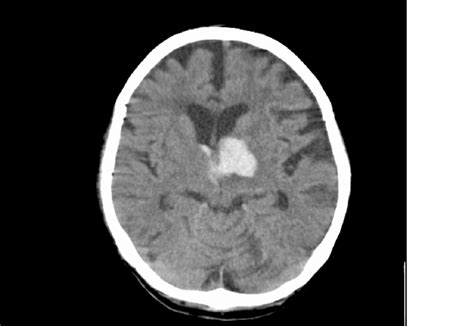 Ct Scan Brain Hemorrhage Ct Scan Machine Images