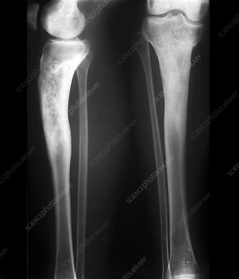 Osteomyelitis In The Lower Leg X Rays Stock Image C0403075