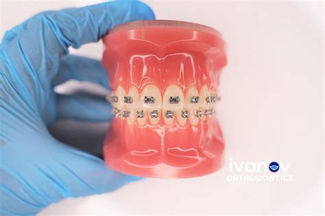 They both have advantages and disadvantages. Braces With Missing Teeth | Teeth Alignment Treatment