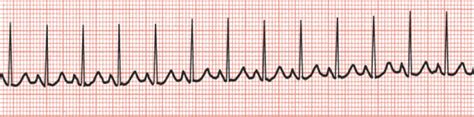 Sinus Rhythms Medictests