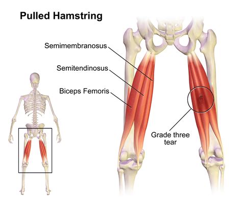 Everything You Need To Know About Hamstring Strains