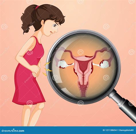 Woman With Ovarian Cancer Stock Vector Illustration Of Icon
