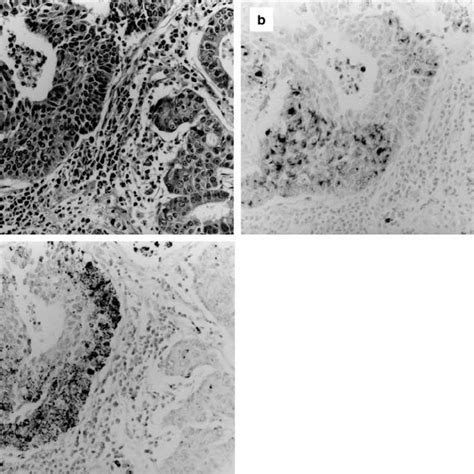 A A Combined Large Cell Neuroendocrine Carcinoma Left And