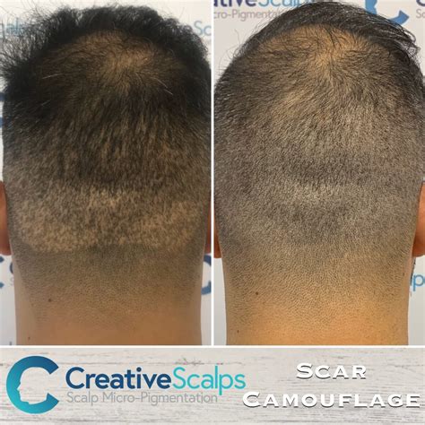 Scalp Micropigmentation Before And After Results Best Smp Results