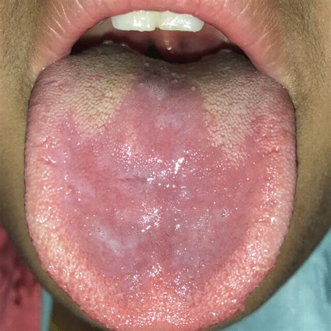 Glossitis With Secondary Infections Download Scientific Diagram