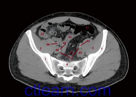 Start studying ct anatomy abd/pelvis. Learn CT Scan: Anatomy CT Axial Abdomen and Pelvis Male