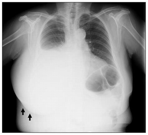 Subcutaneous Seroma After Diagnostic Thoracentesis Cmaj