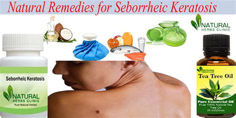To Get Rid Of Seborrheic Keratosis Utilize Natural Remedies