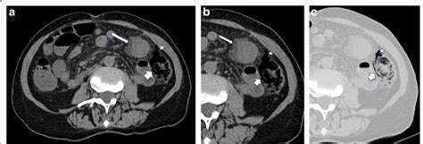 Radiologic Images A Axial View Of Unenhanced Abdominal Ct Showing