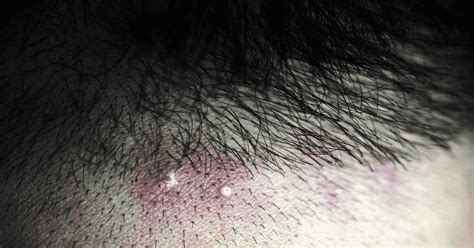Scalp Folliculitis Is A Condition In Which Boils Or Painful Rashes My
