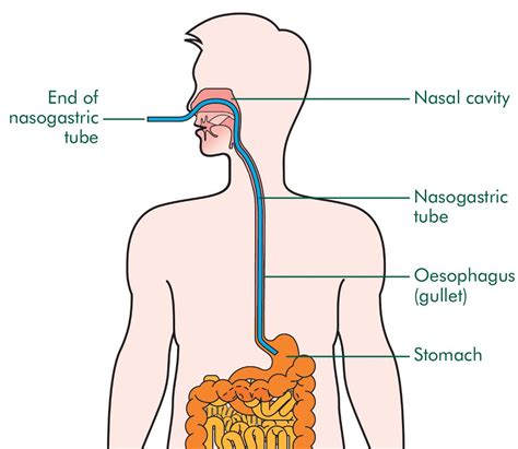 Nasogastric Feeding Tube Causes Symptoms Treatment Nasogastric