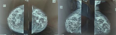 Figure 1 Breast Cancer Mammography Imaging Left Breast