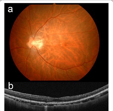 Fundus Photograph And Optical Coherence Tomography Images Of The Left