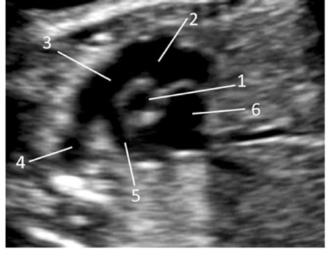 Basal Short Axis View Of Right Ventricular Outflow Tract Circle And