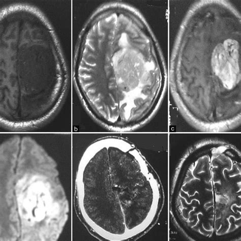 A T1 Weighted Magnetic Resonance Imaging Showing Hypointense Lesion