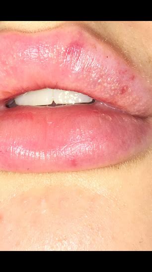 Tiny White Spots On Lips After Filler